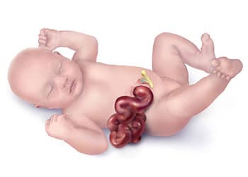 gastrocschisis.